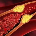 콜레스테롤 수치를 낮추는 6가지 방법